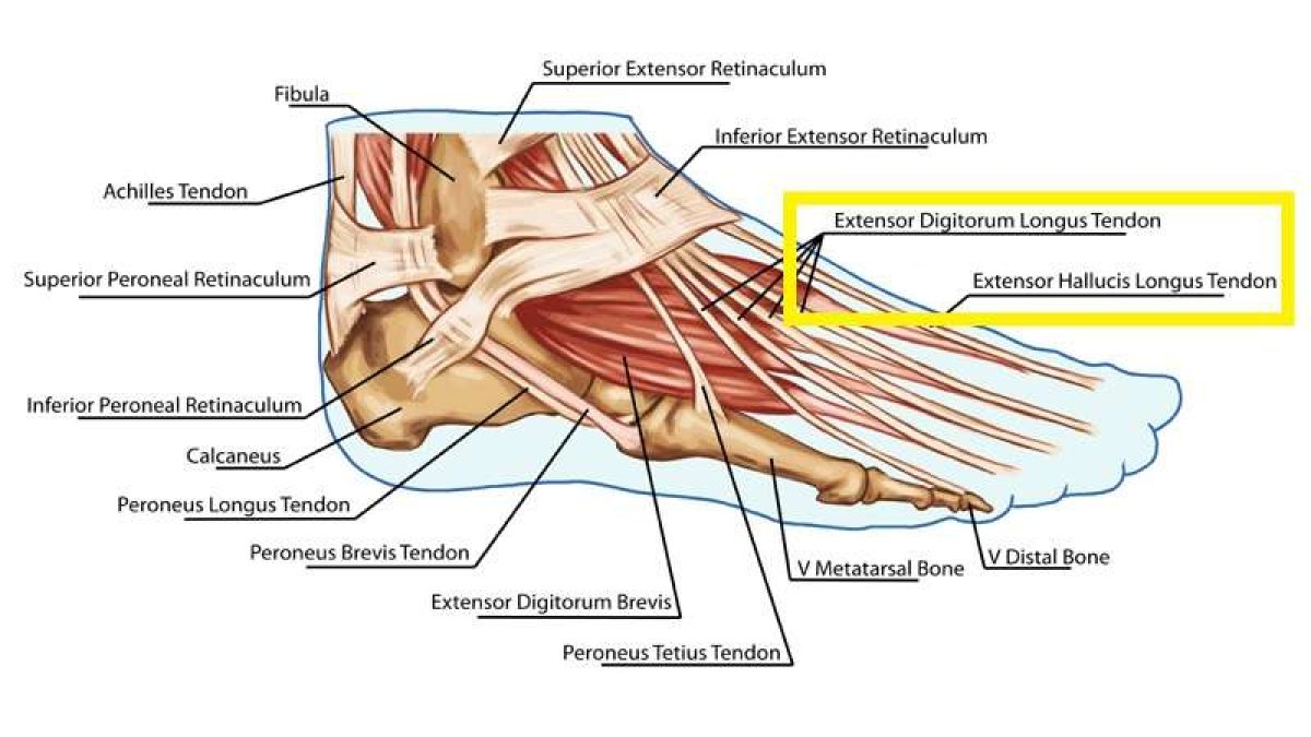 Extensor tendonitis top of foot discount