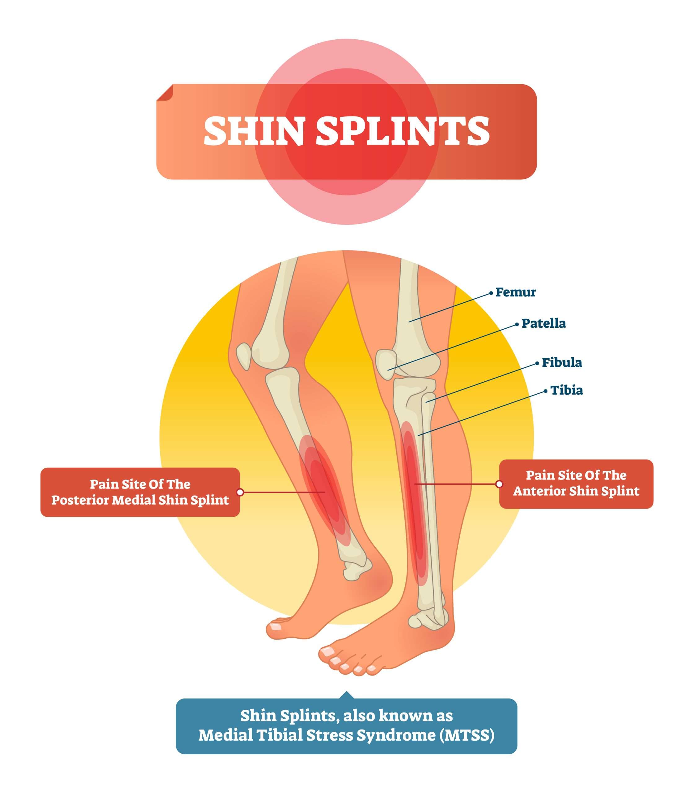 Physiotherapist guiding a runner through calf raise strengthening for shin splints rehab