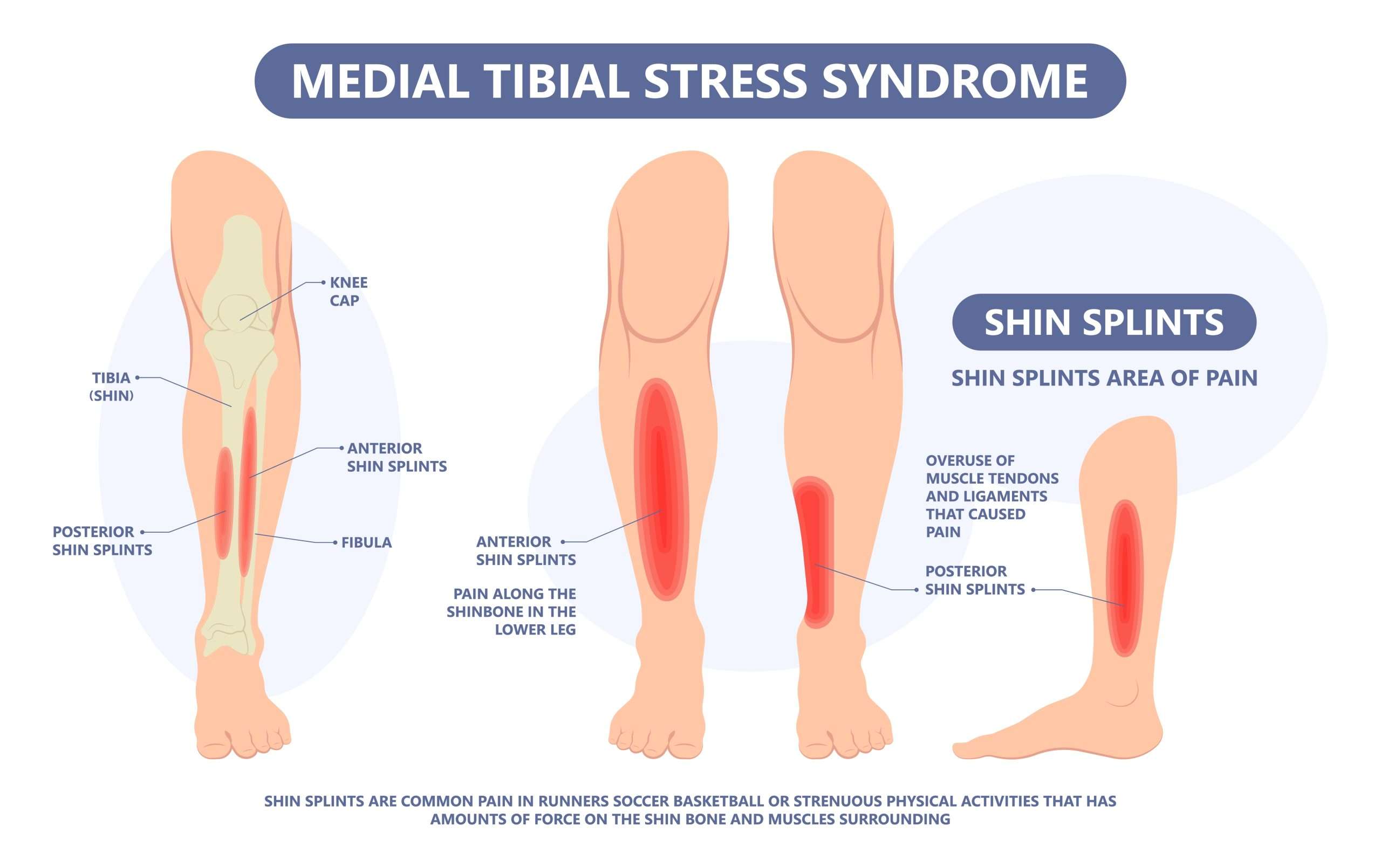 Runner rebuilding strength with a physiotherapist before returning to running after shin splints